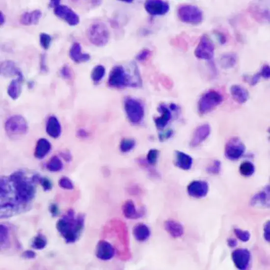 Biopsy - Small Specimen (<2cm) With Image
